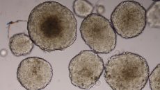 En la imagen: tumores de cáncer de mamá en tercera dimensión. (Imagen: cortesía de Dra. Karla Itzel Vázquez Santillán.)